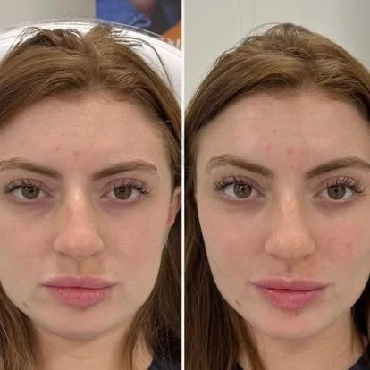 Dermal fillers lip and face result by Rae Cooper, New Aesthetics Chelmsford