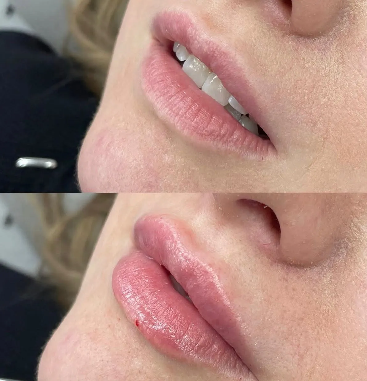 Dermal fillers lip and face result by Rae Cooper, New Aesthetics Chelmsford
