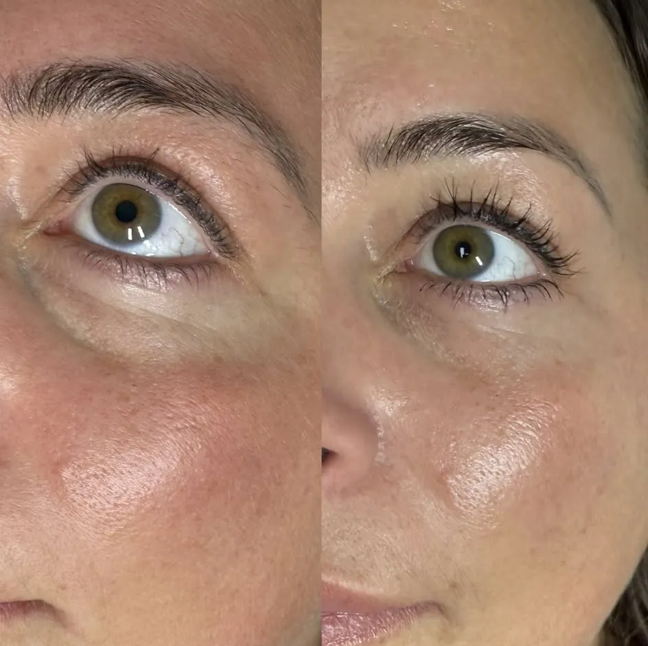 Polynucleotides skin treatment at New Aesthetics, Chelmsford and Maldon