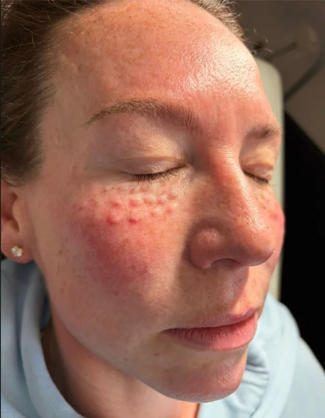 Polynucleotides skin treatment at New Aesthetics, Chelmsford and Maldon