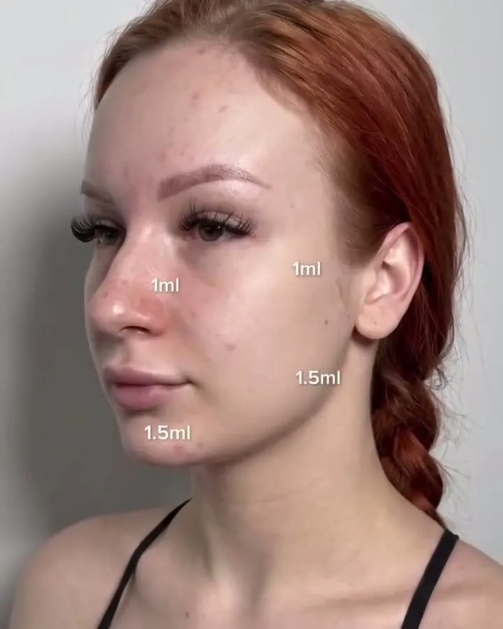Dermal fillers – nose, cheek, jaw and chin – video by Rae Cooper, New Aesthetics Chelmsford and Maldon