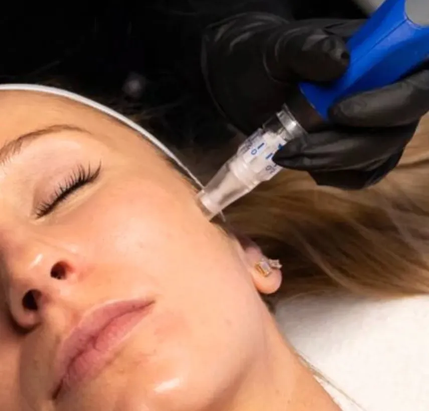 Microneedling skin treatment at New Aesthetics, Chelmsford and Maldon