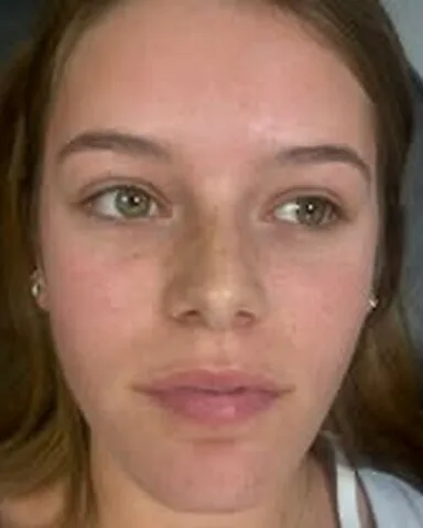 Dermal fillers – lips – before treatment
