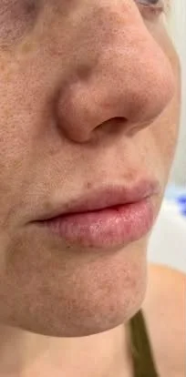 Dermal fillers – lips – before treatment