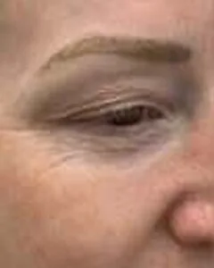 Anti-wrinkle injections – before treatment
