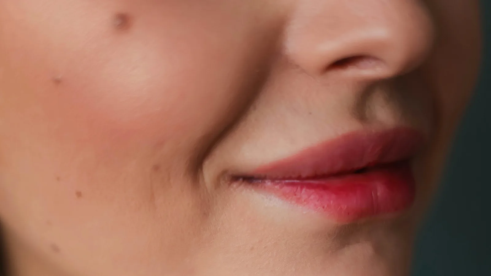 Seventy Hyal skin booster at New Aesthetics, Chelmsford and Maldon