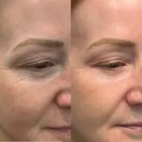 Anti-wrinkle injections result at New Aesthetics, Chelmsford and Maldon