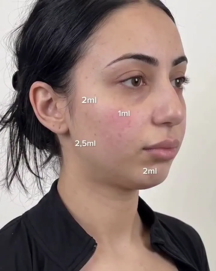 Dermal fillers – cheek, jaw and chin balancing – video by Rae Cooper, New Aesthetics Chelmsford and Maldon