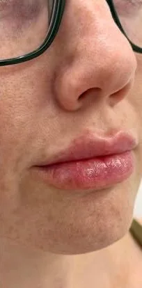 Dermal fillers – lips – after treatment at New Aesthetics, Chelmsford and Maldon