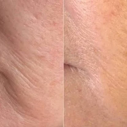 Profhilo skin booster result at New Aesthetics, Chelmsford and Maldon
