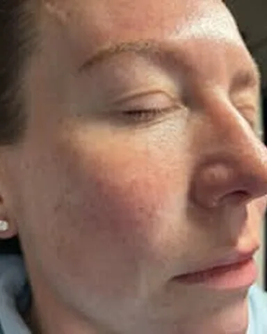 Polynucleotides – skin – after treatment at New Aesthetics, Chelmsford and Maldon