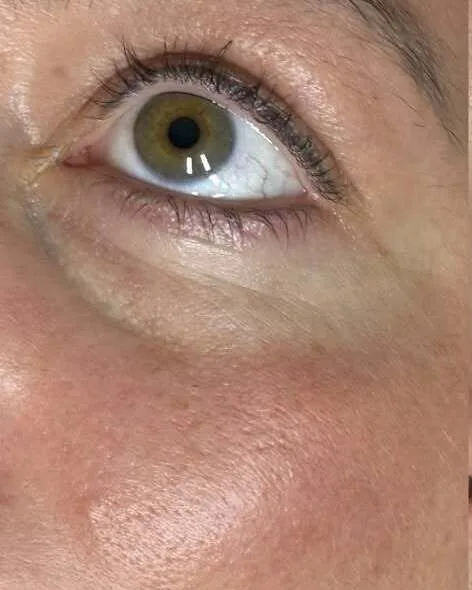 Polynucleotides – under eye – before treatment