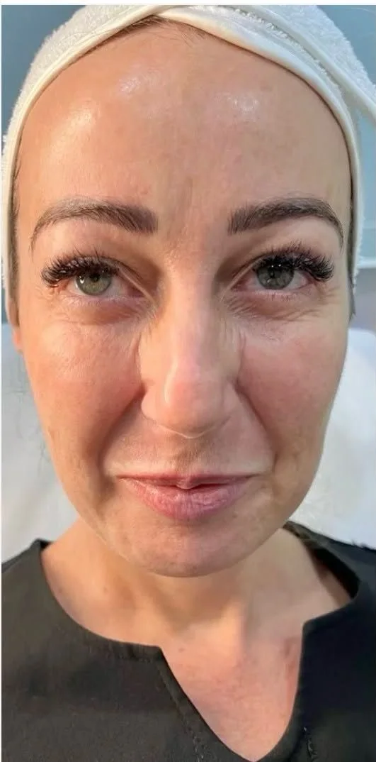 Profhilo skin booster – before treatment