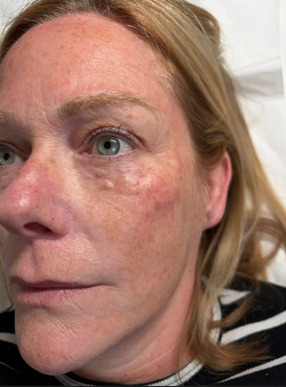 Polynucleotides skin treatment at New Aesthetics, Chelmsford and Maldon