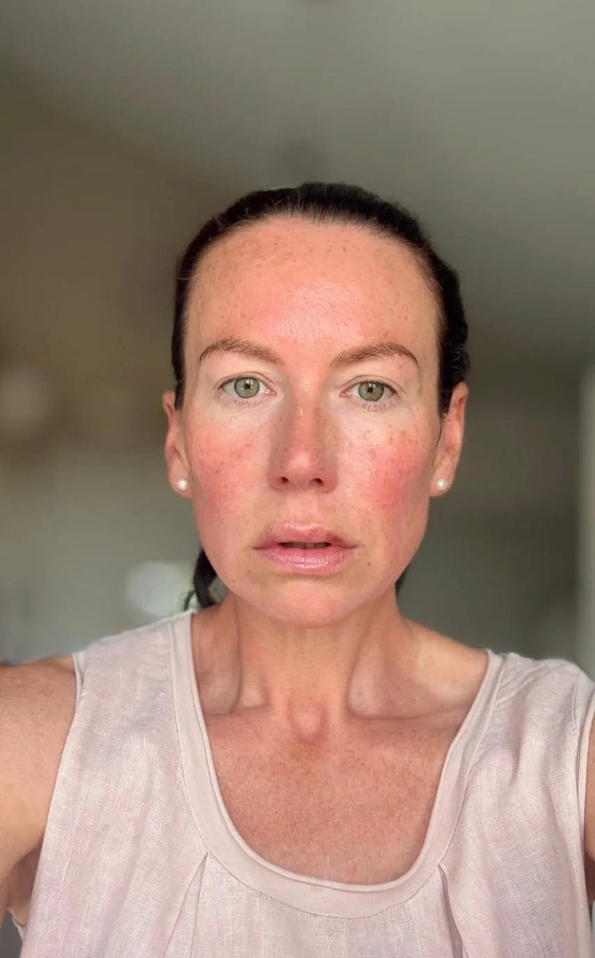 Microneedling result by Rae Cooper at New Aesthetics, Chelmsford and Maldon
