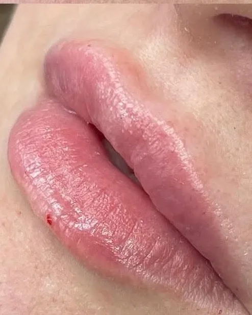 Dermal fillers – lips – after treatment at New Aesthetics, Chelmsford and Maldon