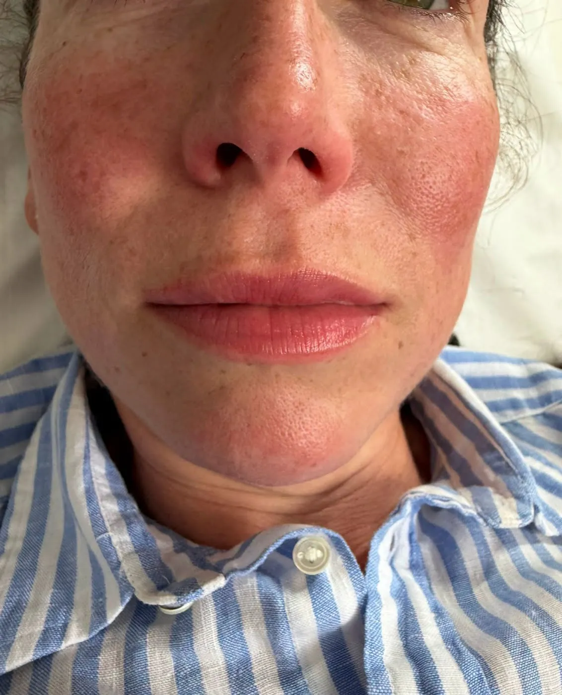 Lip filler result by Rae Cooper at New Aesthetics, Chelmsford and Maldon