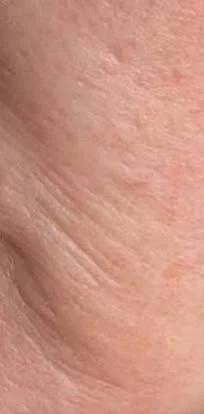 Profhilo skin booster – before treatment