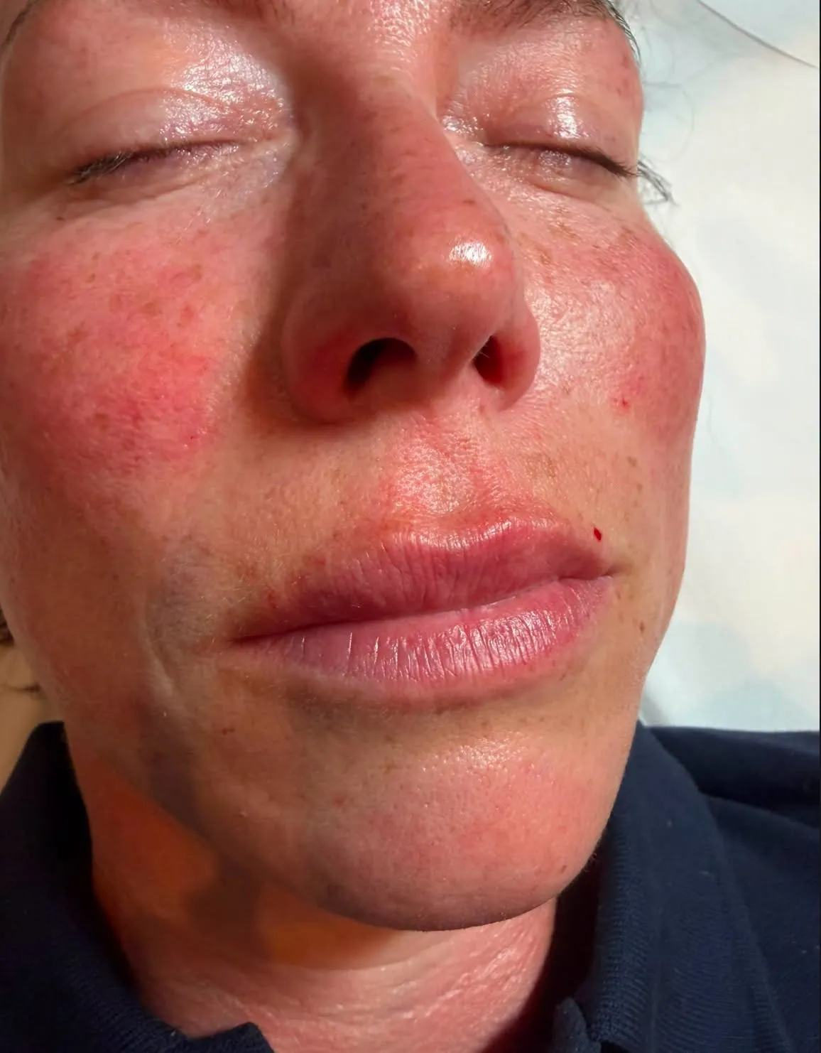 Dermal fillers result by Rae Cooper at New Aesthetics, Chelmsford and Maldon