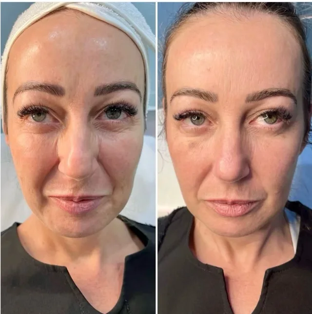 Profhilo skin booster result at New Aesthetics, Chelmsford and Maldon