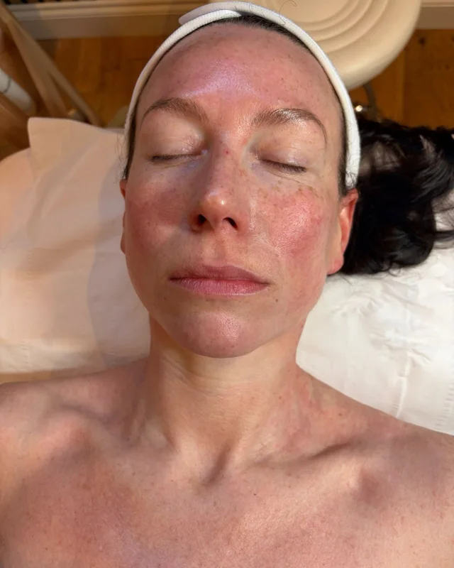 Medical-grade facial treatment at New Aesthetics, Essex