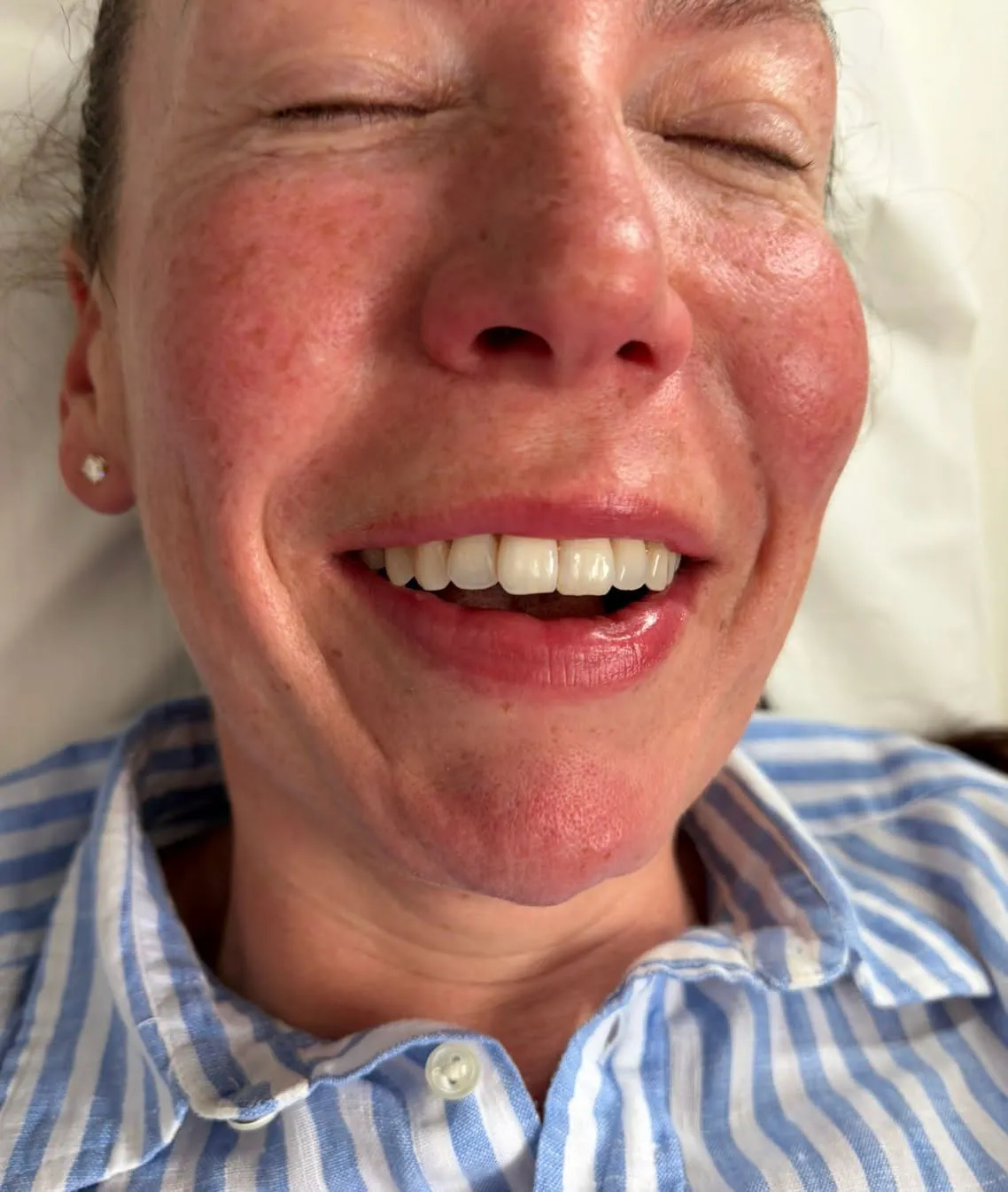 Dermal fillers result by Rae Cooper at New Aesthetics, Chelmsford and Maldon