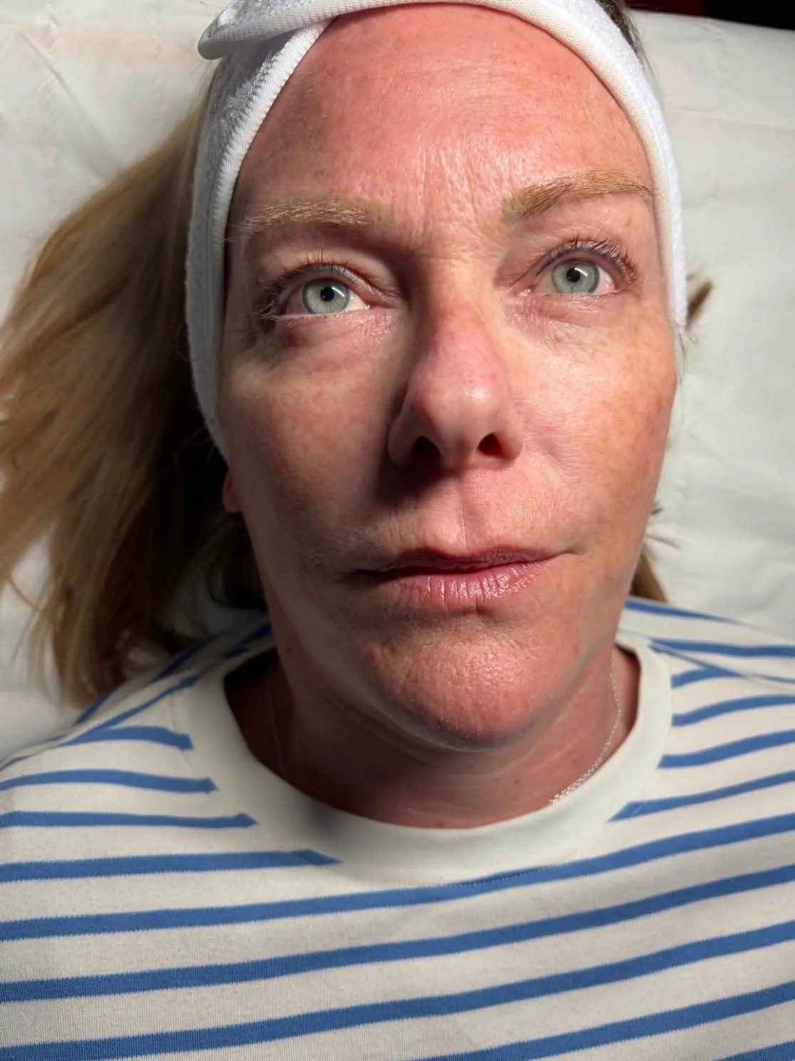 Skin quality result by Rae Cooper at New Aesthetics, Chelmsford and Maldon