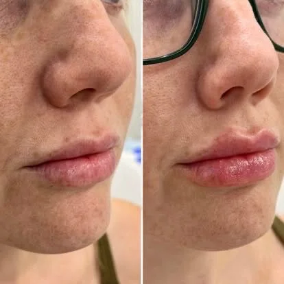 Dermal fillers lip and face result by Rae Cooper, New Aesthetics Chelmsford