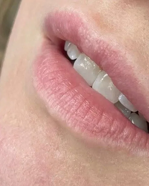 Dermal fillers – lips – before treatment