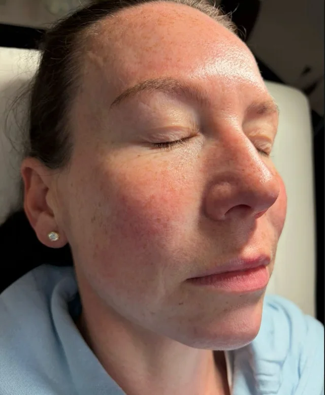 Polynucleotides skin treatment at New Aesthetics, Chelmsford and Maldon