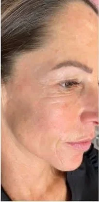 Anti-wrinkle injections – after treatment at New Aesthetics, Chelmsford and Maldon
