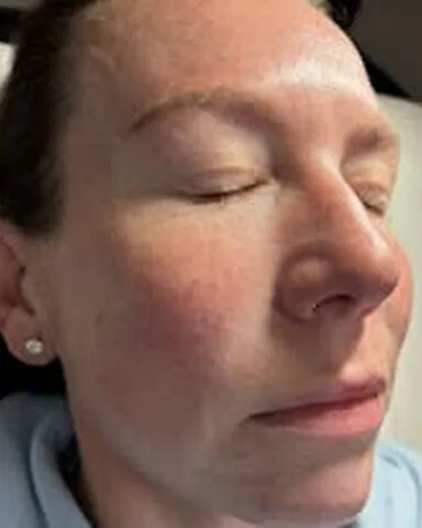 Polynucleotides – skin – before treatment
