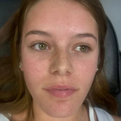 Dermal fillers lip and face result by Rae Cooper, New Aesthetics Chelmsford