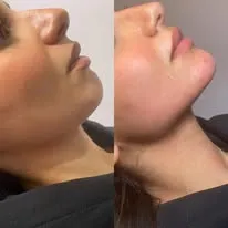 Dermal fillers lip and face result by Rae Cooper, New Aesthetics Chelmsford