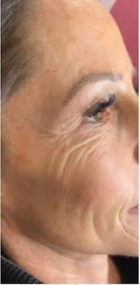 Anti-wrinkle injections – before treatment