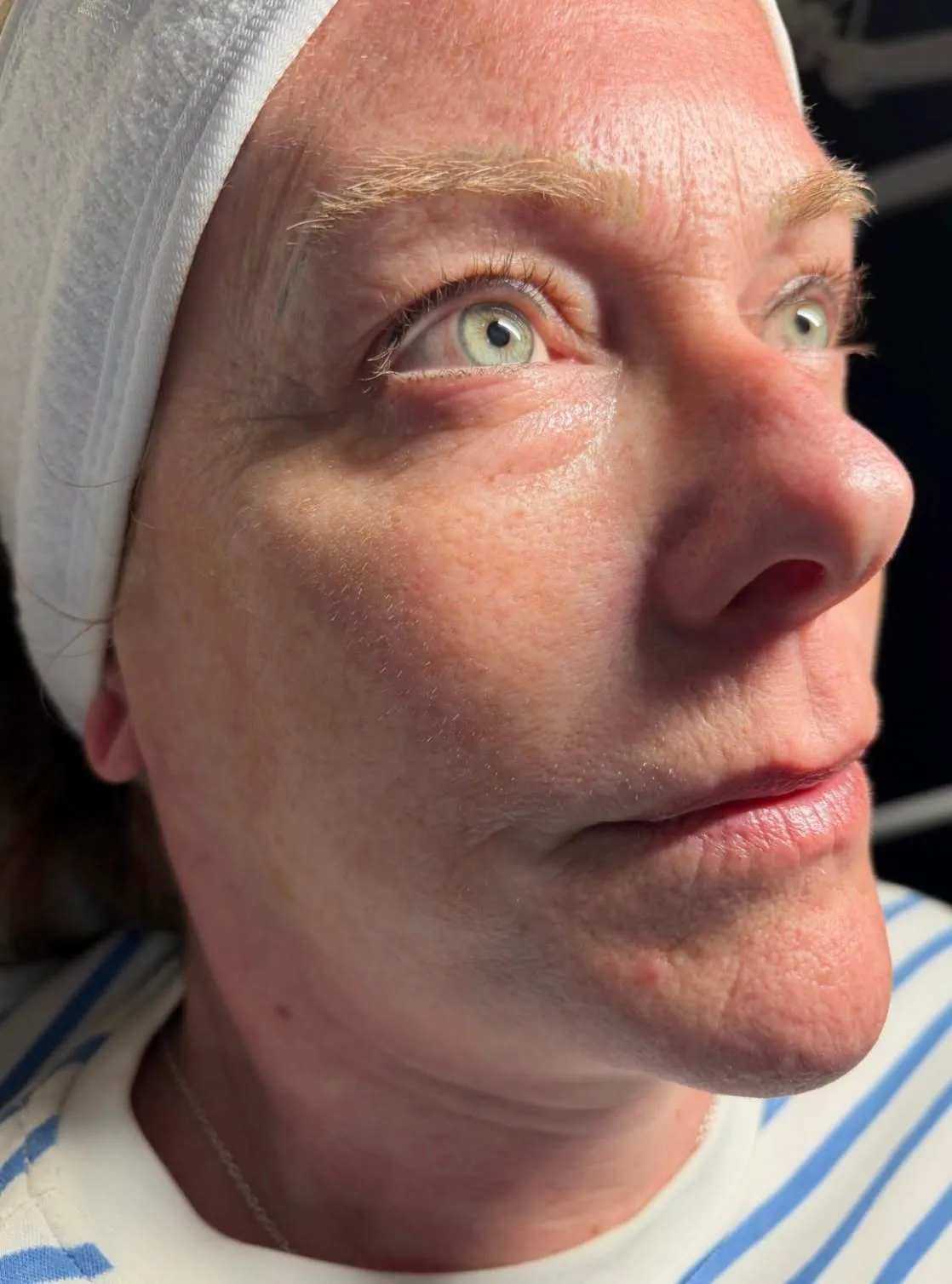 Polynucleotides skin treatment at New Aesthetics, Chelmsford and Maldon