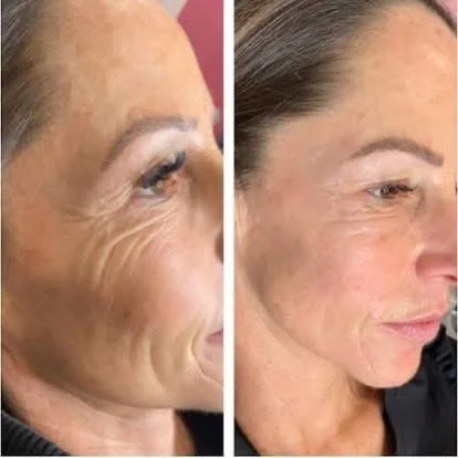 Anti-wrinkle injections result at New Aesthetics, Chelmsford and Maldon