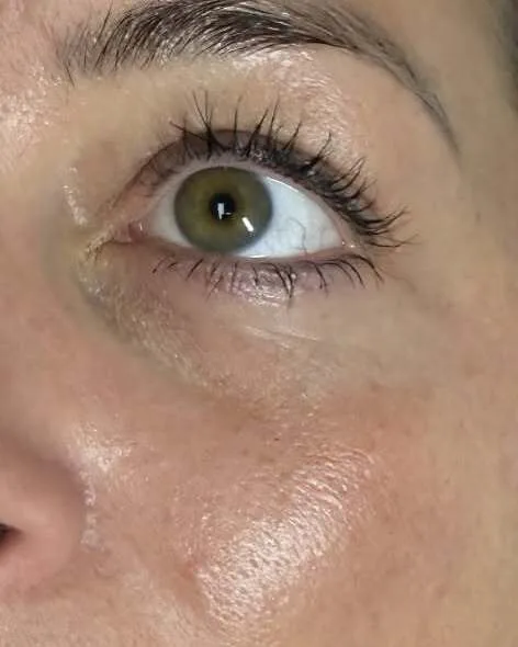 Polynucleotides – under eye – after treatment at New Aesthetics, Chelmsford and Maldon