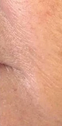Profhilo skin booster – after treatment at New Aesthetics, Chelmsford and Maldon