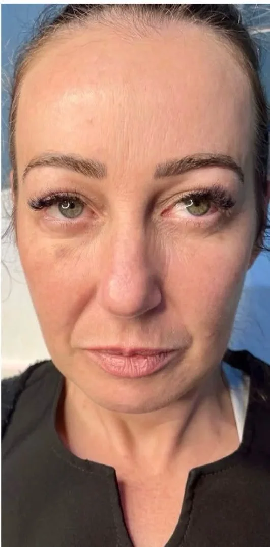 Profhilo skin booster – after treatment at New Aesthetics, Chelmsford and Maldon