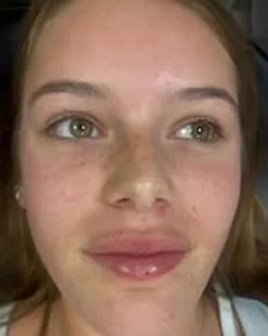 Dermal fillers – lips – after treatment at New Aesthetics, Chelmsford and Maldon