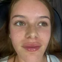 Dermal fillers lip and face result by Rae Cooper, New Aesthetics Chelmsford