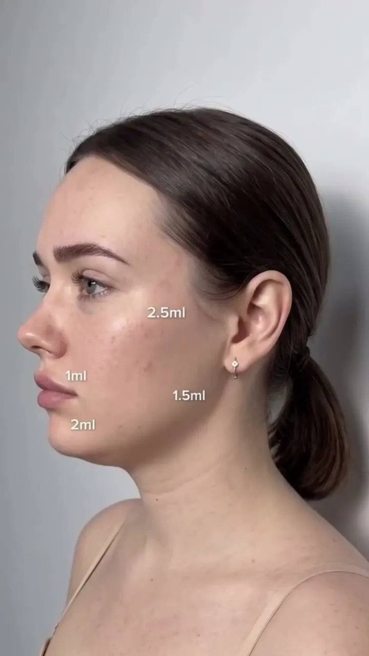 Dermal fillers – side-profile cheek, lip, jaw and chin – video by Rae Cooper, New Aesthetics Chelmsford and Maldon